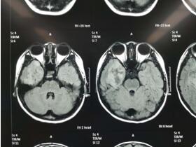 孩子上课注意力不集中 可能背后另有隐患